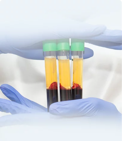 Hand hold viles of platlet rich plasma at Doctors Plus Urgent Care in Concord, NC.