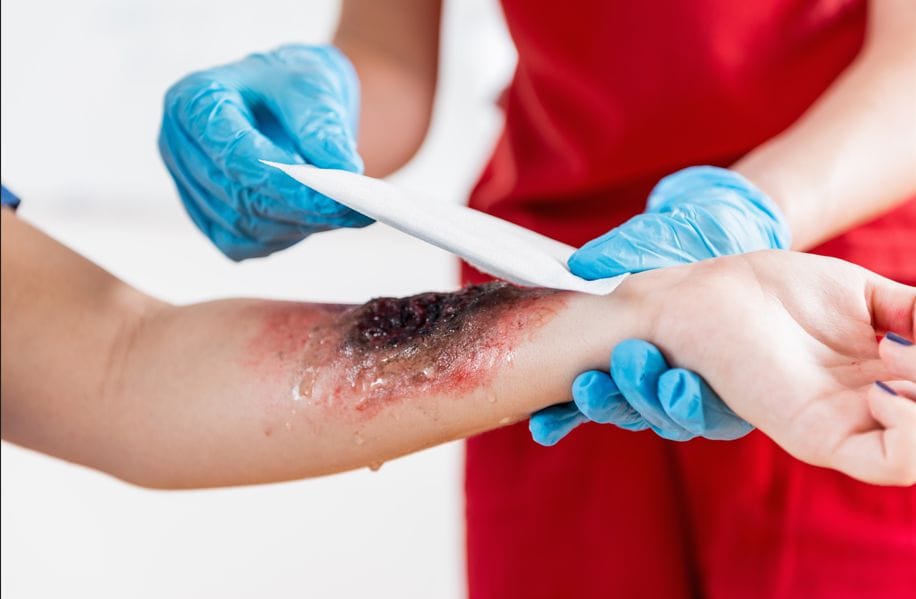 Burns, Cuts & Laceration Care: When to Stitch & How We Help